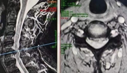 無“微”不至：我院成功完成懷化市第一臺孔鏡輔助下小切口ACDF頸椎手術(shù)